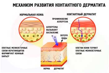 Контактный дерматит