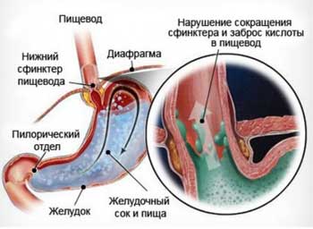 Бессимптомный рефлюкс