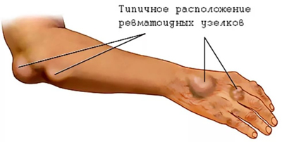 Ревматическая лихорадка (ревматизм)
