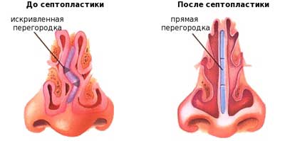 Септопластика