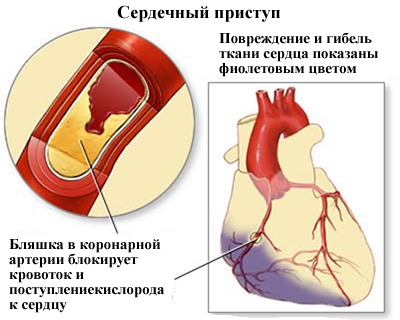 Первая помощь при сердечном приступе