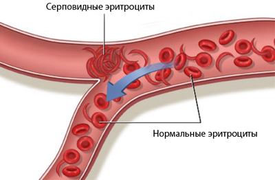 Серповидно-клеточная анемия