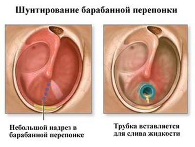 Перфорация барабанной перепонки