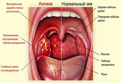 Как распространяется ангина