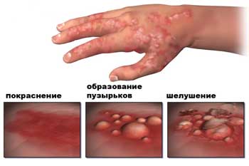 Контактный дерматит