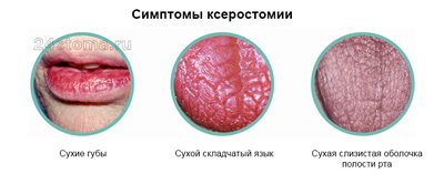 Ксеростомия, или сухость во рту: причины, симптомы, лечение