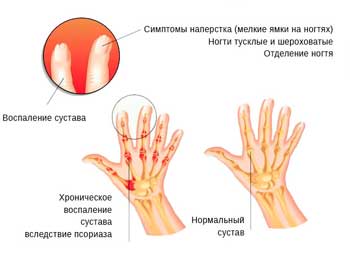 Псориатический артрит