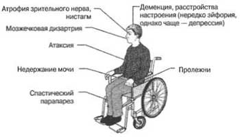 Что такое рассеянный склероз