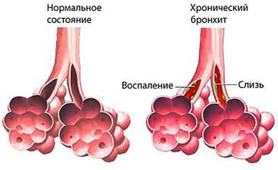 Профилактика и лечение бронхита