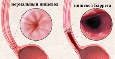 Гастроэзофагеальная рефлюксная операция