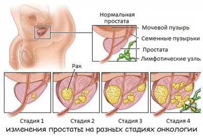 Рак предстательной железы