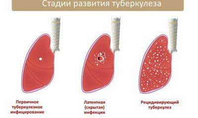 симптомы и лечение туберкулеза
