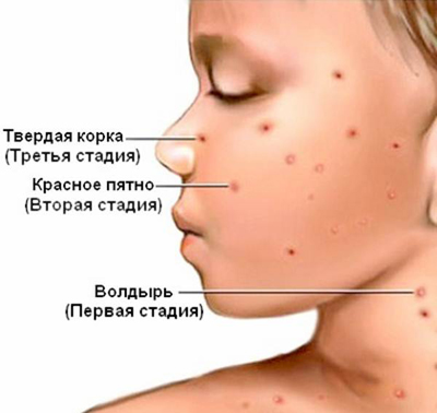 Ветрянка (ветряная оспа)