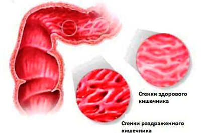 Как справиться с синдромом раздраженного кишечника