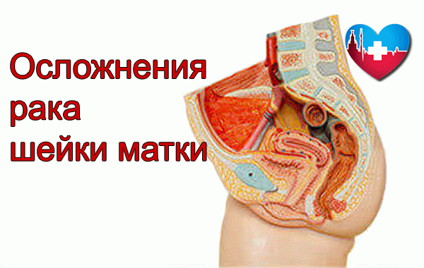 Осложнения после рака шейки матки Осложнения после рака шейки матки