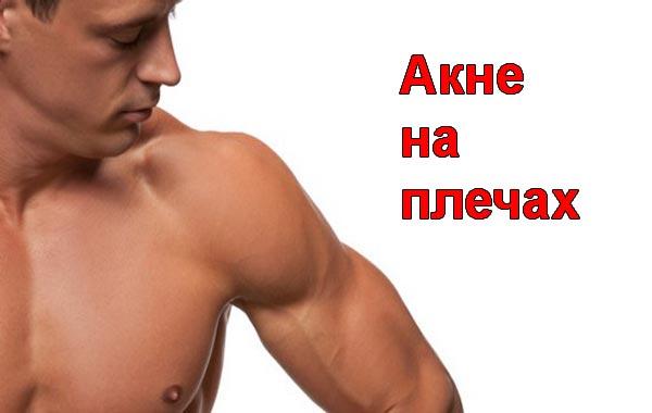 Советы как избавиться от прыщей на плечах Советы как избавиться от прыщей на плечах