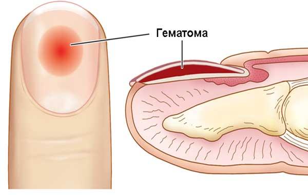 Кровь под ногтем Гематома под ногтем
