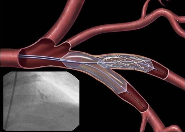 Коронарное стентирование