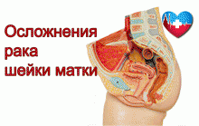 Осложнения после рака шейки матки Осложнения после рака шейки матки