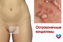 Остроконечные кондиломы Остроконечные кондиломы