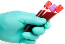 Флеботомия (кровопускание): цель и описание процедуры Флеботомия (кровопускание): цель и описание процедуры