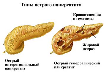 Симптомы панкреатита