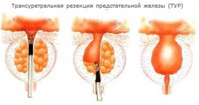 Трансуретральная резекция предстательной железы