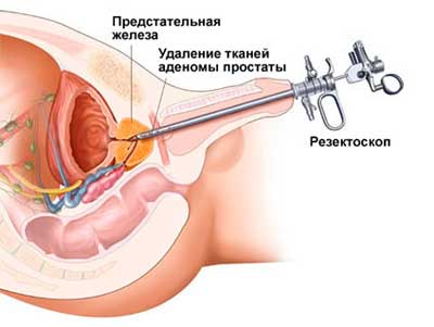 Трансуретральная резекция предстательной железы
