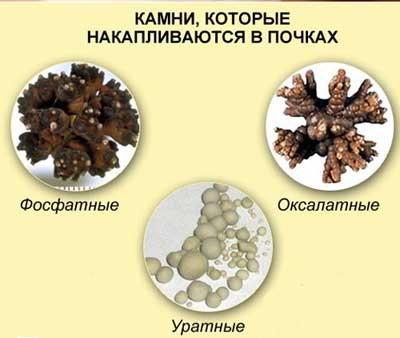 Как лечить мочекаменную болезнь