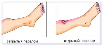 Первая помощь при переломе