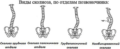 Сколиоз: природа, диагностика, лечение