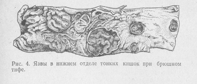 Брюшной тиф