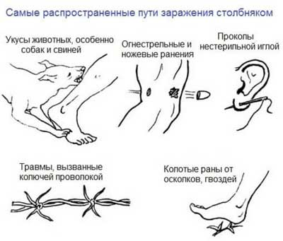 Причины и симптомы столбняка
