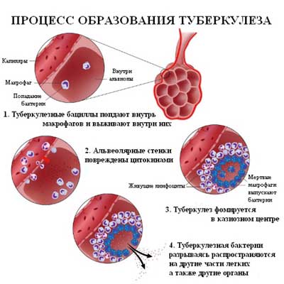 симптомы и лечение туберкулеза